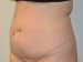 Tummy Tuck Before Patient Thumbnail 2