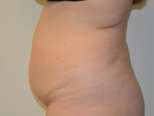 Tummy Tuck Before Patient 3