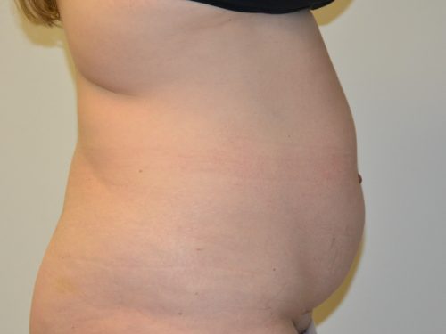 Tummy Tuck Before Patient 5