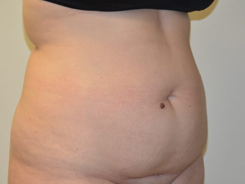 Tummy Tuck Before Patient 4