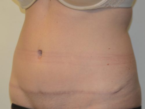 Tummy Tuck After Patient 2