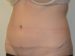 Tummy Tuck After Patient Thumbnail 2