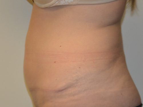 Tummy Tuck After Patient 3