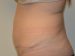 Tummy Tuck After Patient Thumbnail 3