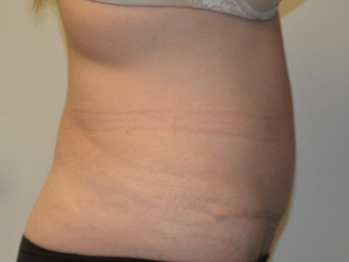 Tummy Tuck After Patient 5