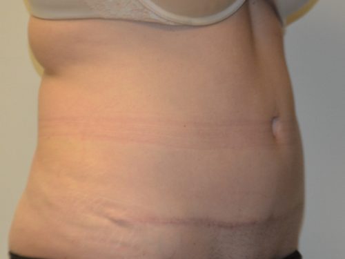 Tummy Tuck After Patient 4