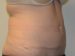 Tummy Tuck After Patient Thumbnail 4