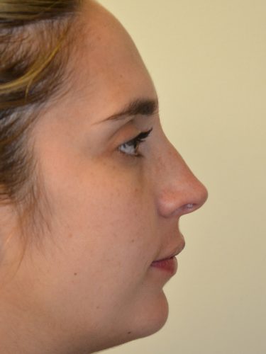 Rhinoplasty Before Patient 2