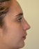 Rhinoplasty Before Patient Thumbnail 2