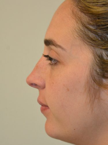 Rhinoplasty Before Patient 4