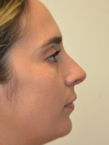 Rhinoplasty After Patient 2