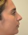 Rhinoplasty After Patient Thumbnail 2