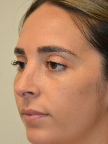 Rhinoplasty After Patient 5