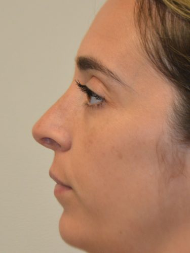 Rhinoplasty After Patient 4