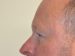 Eyelid Surgery Before Patient Thumbnail 5