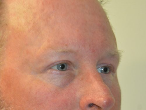 Eyelid Surgery After Patient 1