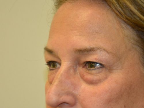 Eyelid Surgery Before Patient 5