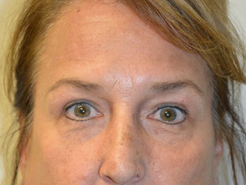 Eyelid Surgery After Patient 1