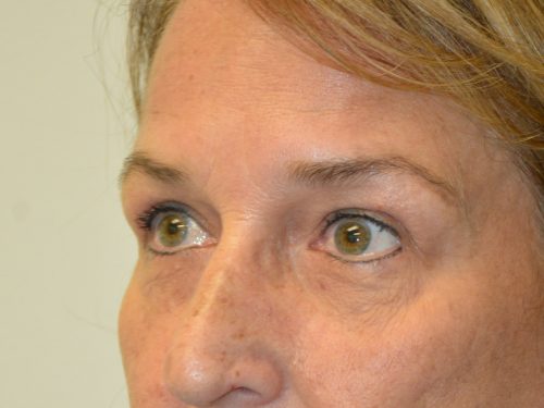 Eyelid Surgery After Patient 5