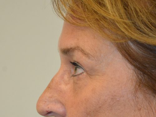 Eyelid Surgery After Patient 4