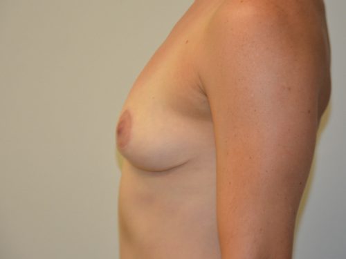 Breast Implant Removal After Patient 3