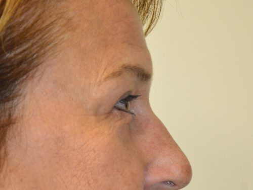 Eyelid Surgery After Patient 3