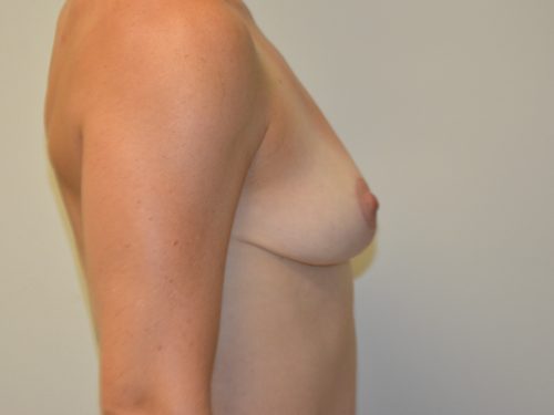 Breast Lift After Patient 5