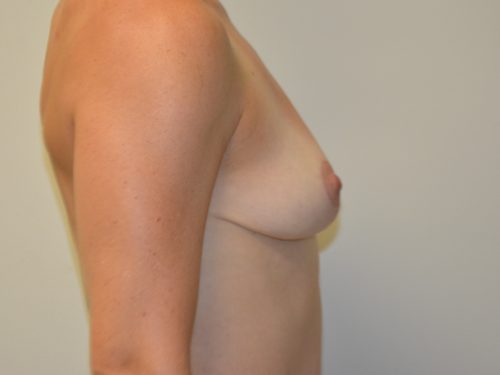 Breast Implant Removal After Patient 5