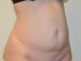 Tummy Tuck Before Patient Thumbnail 2