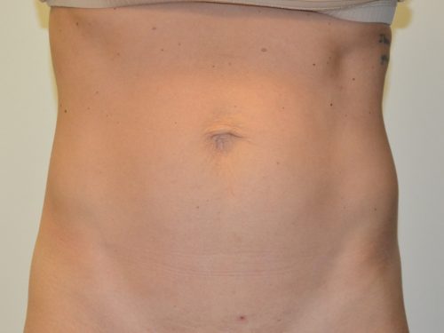 Mini Tummy Tuck Before Patient 1