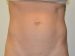 Mini Tummy Tuck Before Patient Thumbnail 1