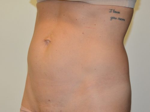 Mini Tummy Tuck Before Patient 4