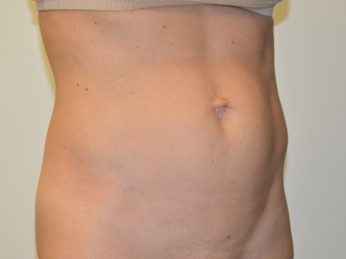 Mini Tummy Tuck Before Patient 2