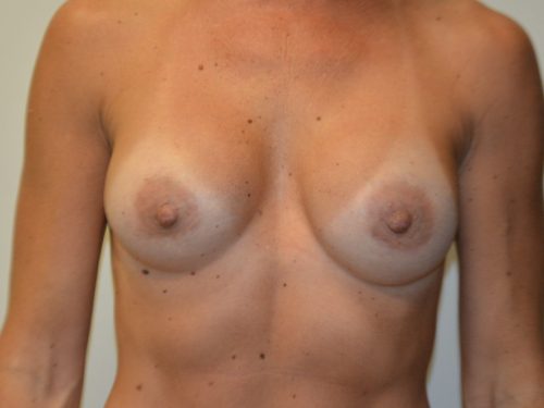 Breast Revision Before Patient 1