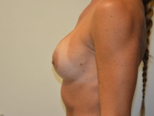Breast Revision Before Patient 3