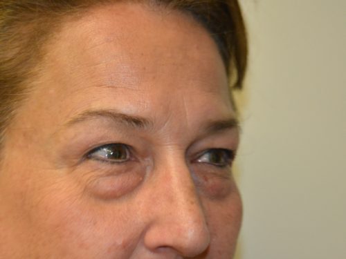 Eyelid Surgery Before Patient 2