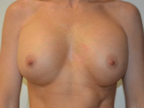 Breast Revision Before Patient 1