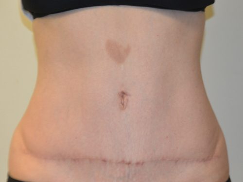 Tummy Tuck After Patient 1