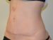 Tummy Tuck After Patient Thumbnail 4