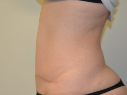 Tummy Tuck After Patient 5