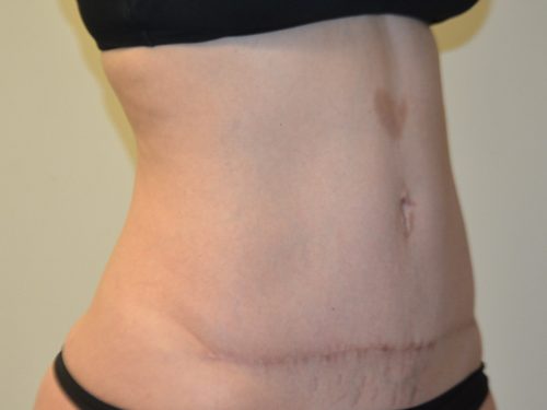 Tummy Tuck After Patient 2