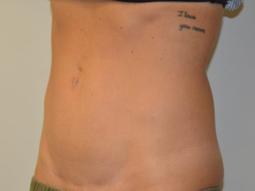 Mini Tummy Tuck After Patient 4