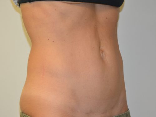 Mini Tummy Tuck After Patient 2