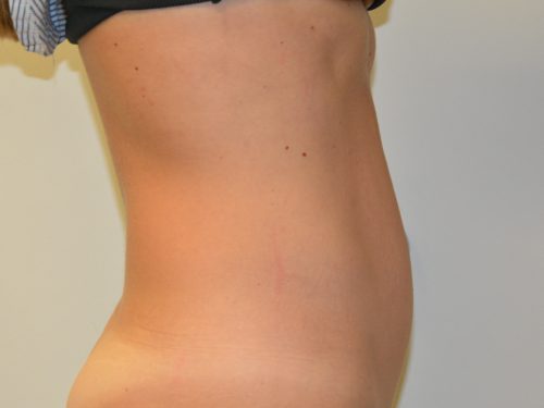 Mini Tummy Tuck After Patient 3