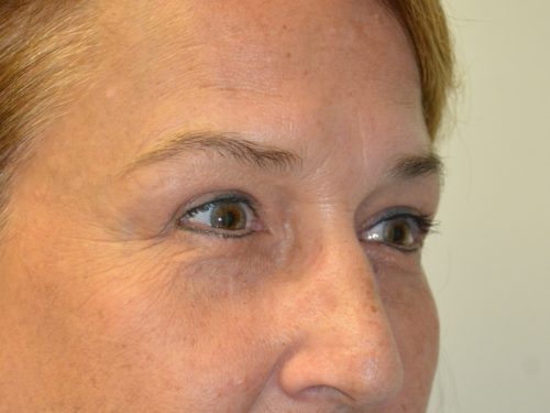 Eyelid Surgery After Patient 2