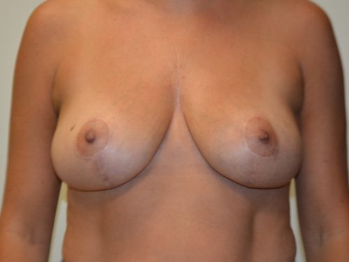 Breast Reduction After Patient 1