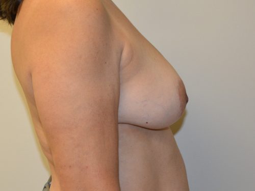 Breast Reconstruction Tissue Expanders Before Patient 5