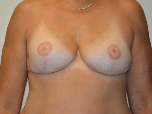 Breast Reconstruction Tissue Expanders After Patient 1