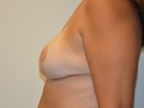 Breast Reconstruction Tissue Expanders After Patient 3