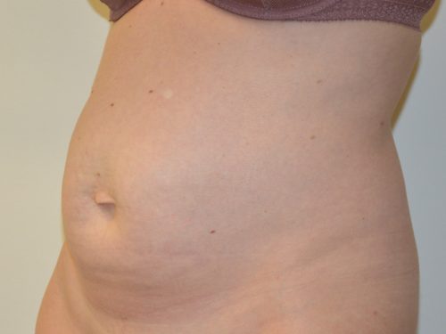 Tummy Tuck Before Patient 2